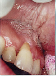 photo of corrugated tissue in maxillary anterior area