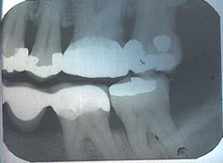 bite-wing xray of left molar area