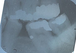 left molar BWX