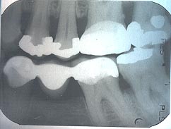 bite-wing xray of left premolar area