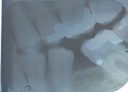 left premolar BWX