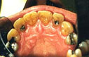 photo of maxillary anteriors