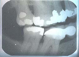 bite-wing xray of right molar area