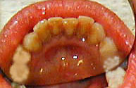 photo of mandibular anteriors