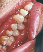 photo of right side occlusion with stain